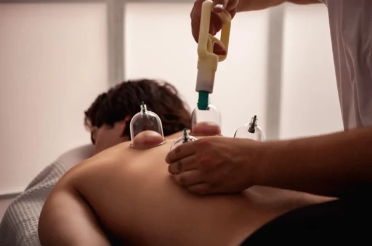 Cupping -